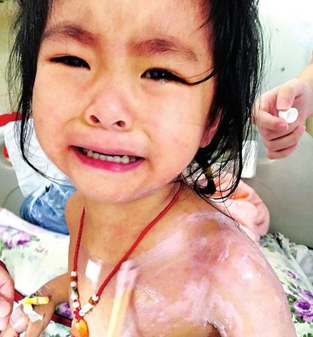 3歲的蘭蘭，全身紅疹，因疼癢難忍而大哭
