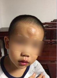 男童被送快遞的電動車撞飛一米多，額頭腫起乒乓球大的包